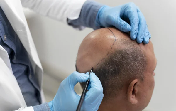 Hair Transplant