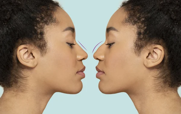 Rhinoplasty