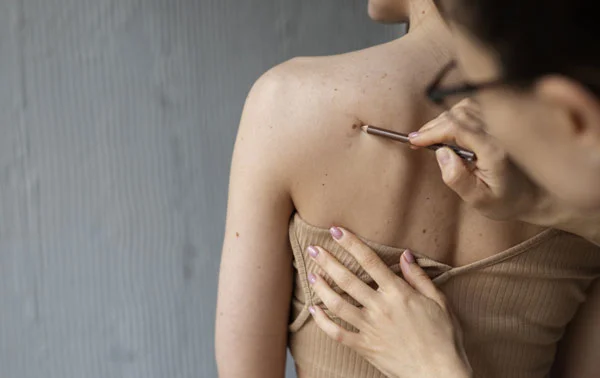 Scar and Mole Removal