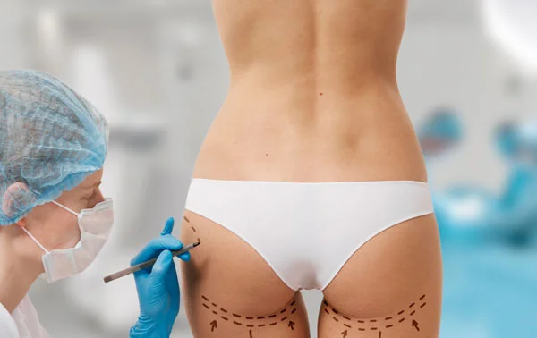 Buttock Lift